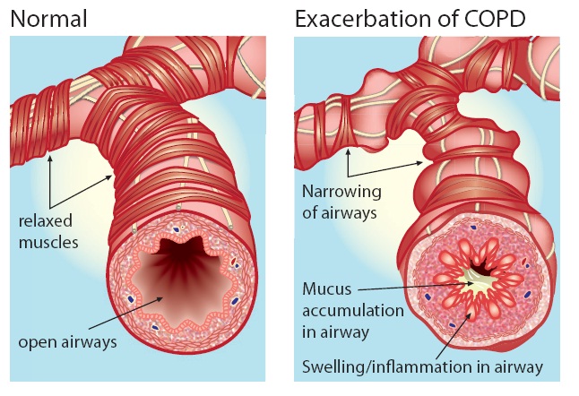Exacerbation of COPD