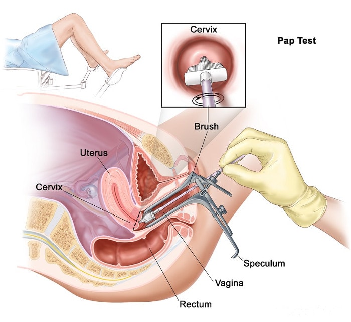 COBAS -TEST: Xét nghiệm tầm soát ung thư cổ tử cung kết hợp tìm HPV với độ nhạy 95-99%